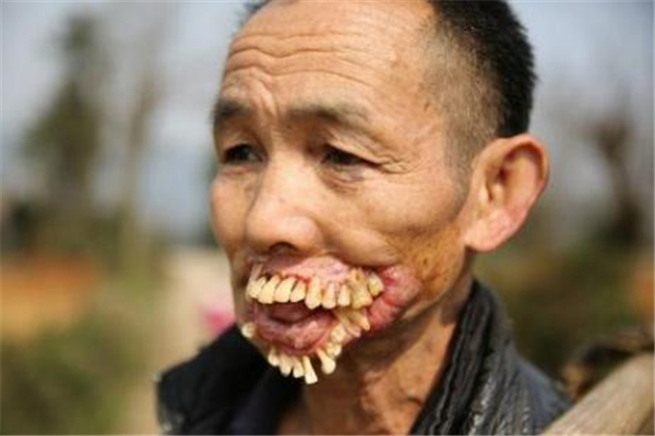 世界上牙齿最多的人 来自印度的小男孩（拥有526颗牙）（世界上牙齿最多的人叫什么名字）